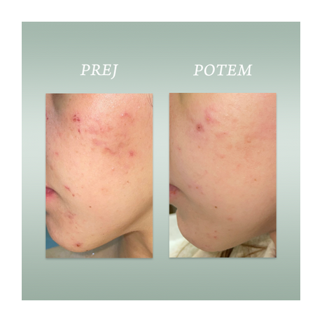Afrodita PURE SKIN SOLUTION Pattanások elleni koncentrátum spray arcra és testre